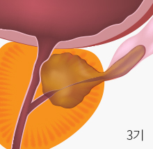 3기 전립선 암