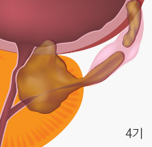 4기 전립선 암