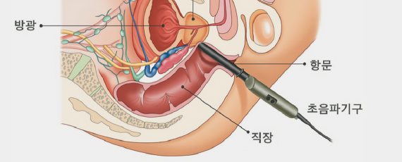 전립선 초음파 검사