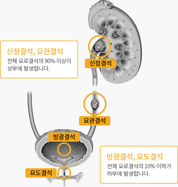 요로결석이 발생하는 부위