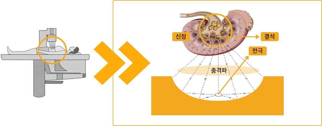 체외충격파쇄석술의 시술 모습