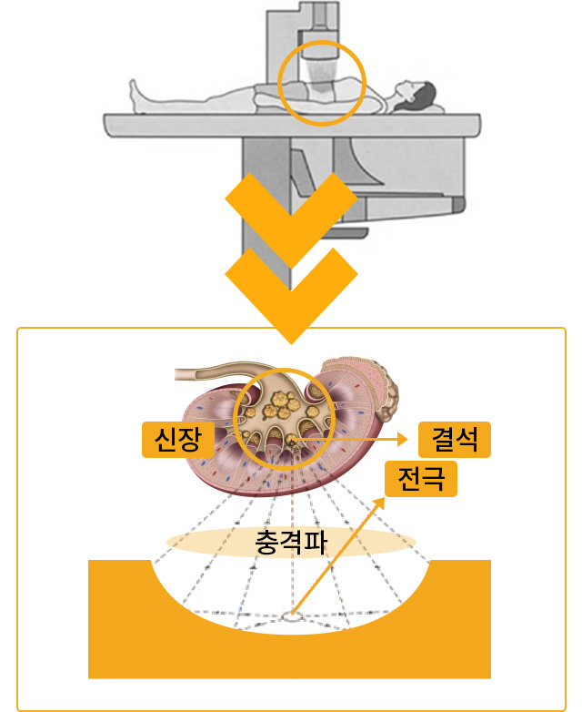 체외충격파쇄석술의 시술 모습