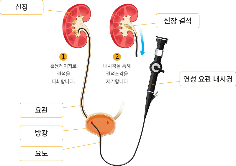 요관내시경 수술