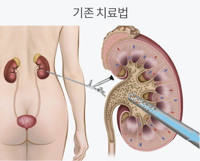 경피적 신절석술