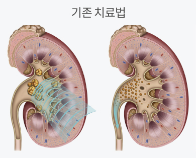 체외충격파쇄석술