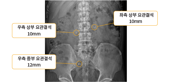 신장요관방광단순촬영(KUB) 검사