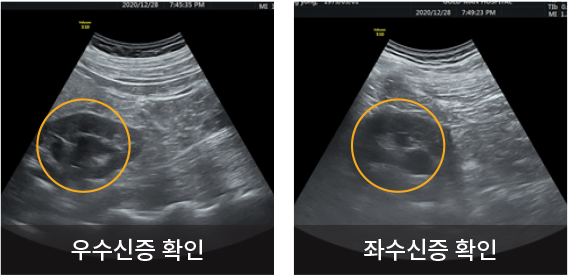 초음파 검사