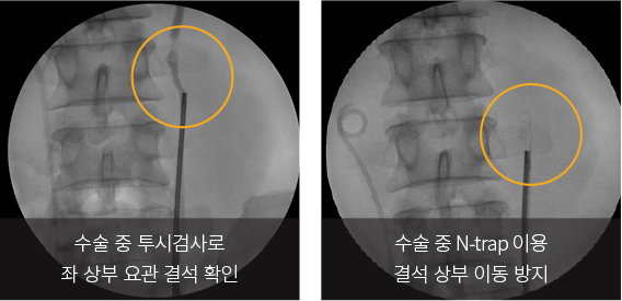 수술 중 C-arm 확인