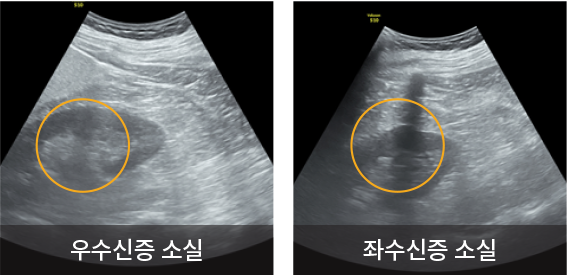 요관내시경 확인