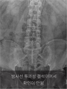 신장요관방광단순촬영(KUB) 검사