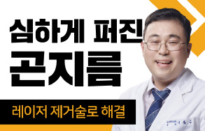 심하게 퍼진 곤지름 - 레이저 제거술로 해결