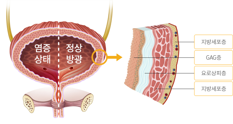 다양한 원인 인자들이 복합적으로 작용