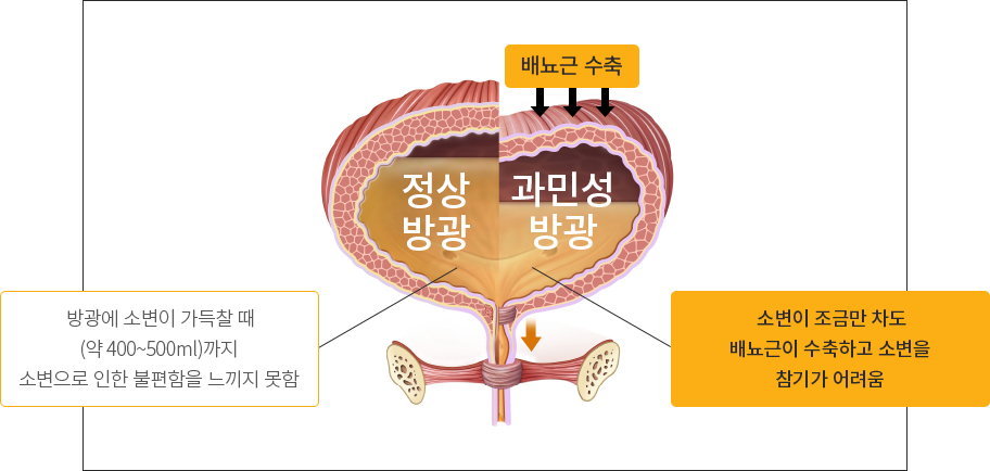 방광에 염증은 없으나 소변을 자주 보고 소변을 참지 못하는 증상이 나타나는 질환