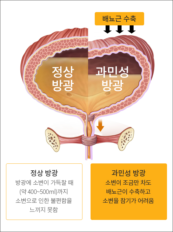 방광에 염증은 없으나 소변을 자주 보고 소변을 참지 못하는 증상이 나타나는 질환