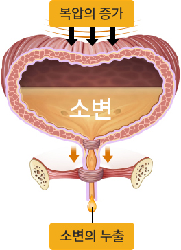 복압서 요실금의 방광