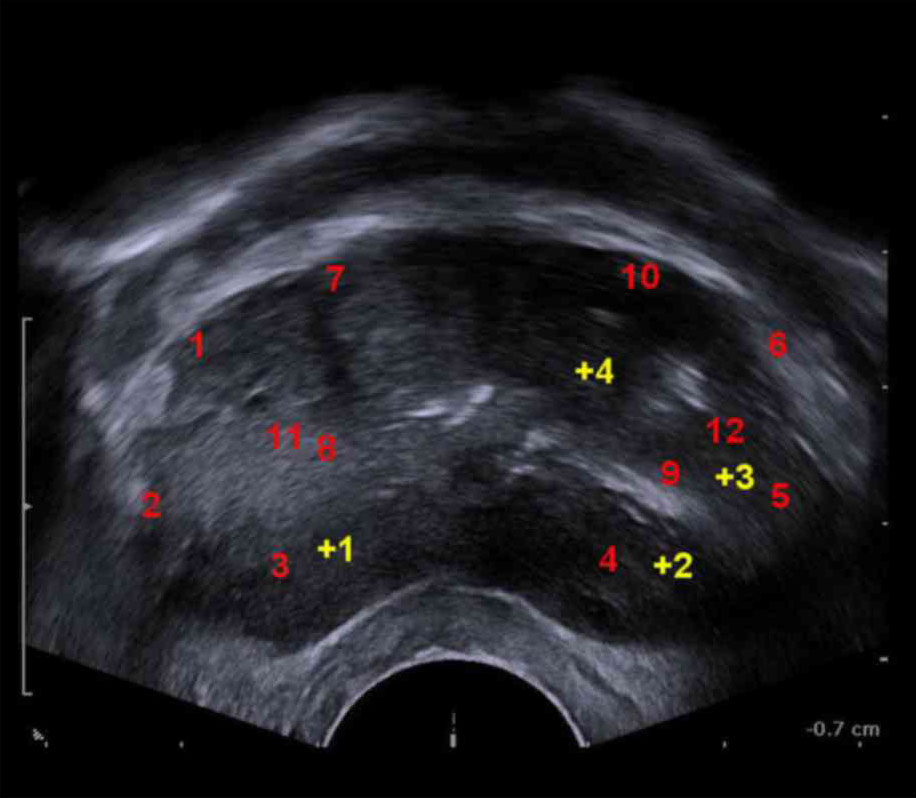 Random 12-Site Biopsy