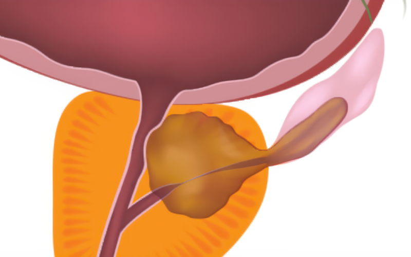 국소 전이된 전립선암 일러스트