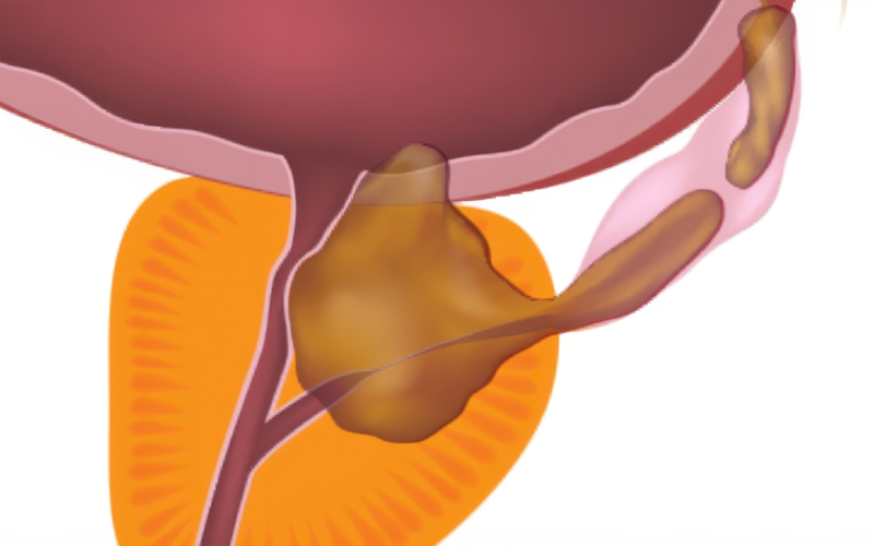 전이 전립선암 일러스트